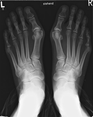 Die Fussverst�mmelung eines
                                  Spreizfuss mit Schiefzehe (Hallux
                                  valgus), hier an einem R�ntgenfoto
                                  sichtbar
