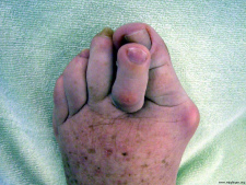 Fussverst�mmelung
                          durch St�ckelschuhe: Reiterzehe �ber
                          Schiefzehe (Hallux Valgus) mit Spreizfuss und
                          H�hneraugen und wunden Stellen (02)